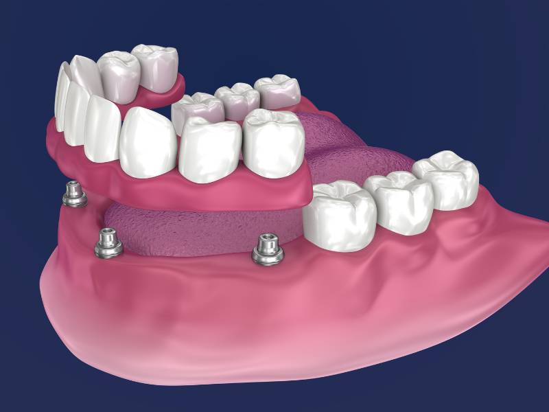 Example of what all-on-4 dental implants - also called implant-supported dentures - look like. 